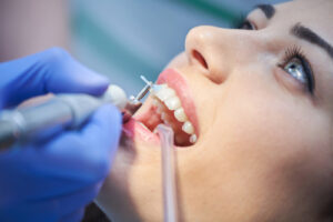 Close Up of a patient getting teeth cleaning in Plano, TX